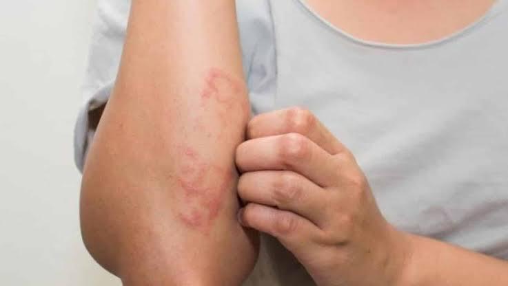 Dia Nacional de Combate e Prevenção da Hanseníase: doença registra cerca de 30 mil novos casos por ano no Brasil