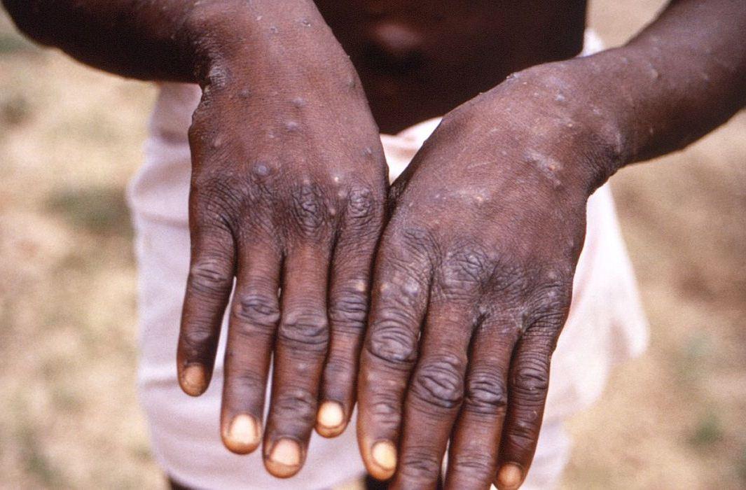 Brasileiro tem 1º caso de varíola dos macacos registrado na Alemanha