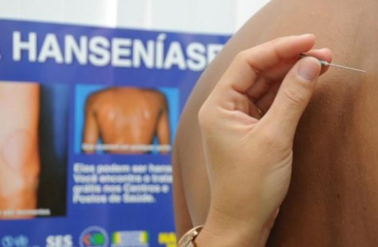 Dia Nacional de Combate e Prevenção da Hanseníase: Brasil teve mais de 17 mil casos da doença em 2022 Dia Nacional de Combate e Prevenção da Hanseníase: Brasil teve mais de 17 mil casos da doença em 2022