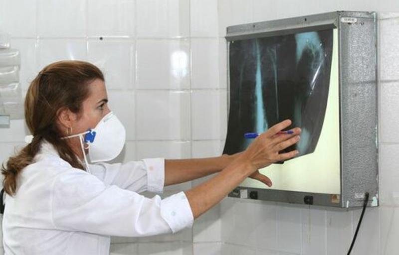 TUBERCULOSE: tratamento interrompido pode gerar formas mais graves da doença