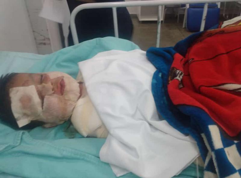 Criança de 5 anos sofre queimaduras graves e escola realiza campanha solidária