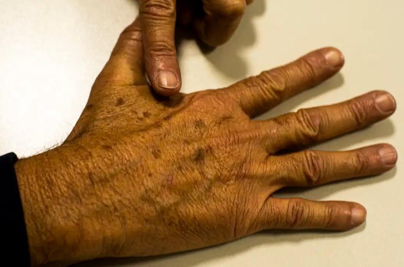 SUS pode gastar R$ 7,84 bi em 2040 com tratamento de câncer, diz Inca