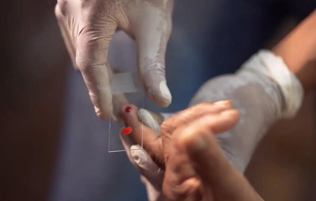 SUS começa a usar novo tratamento contra a malária em crianças