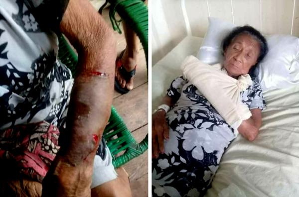 Idosa é espancada e tem braço quebrado pelo próprio neto em Barreirinha